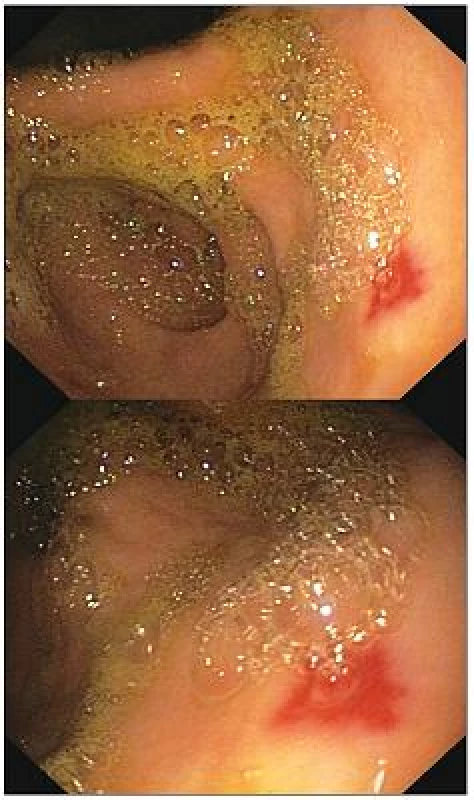 Fibroendoskopický obraz prisadlého polypoidného útvaru s ulceráciou na povrchu
Obr. 2. Sessile polypoid tumor with ulceration on the top
