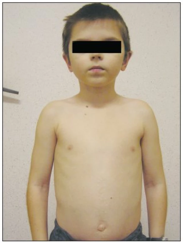 Dieťa 2 roky po operácii
Fig. 2. The child patient 2 years after the procedure