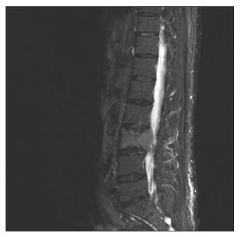 MR lumbosakrální páteře, sagitální sken, STIR zobrazení. Patologická fraktura obratle L3
Fig. 1. MRI, lumbosacral spine, sagittal view, STIR imaging. A pathological fracture of L3