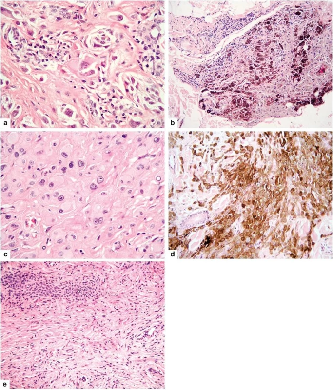 Hlavní cytologické varianty MELTUMP
a – spitzoidní
b – hluboko penetrující névus napodobující
c – epiteloidní
d – pigmentovaný epiteloidní melanocytom
e – desmoplastická