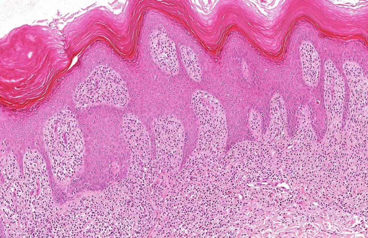 Kožní mastocytom, přehled: hustě nakupené mastocyty v horním koriu HE, obj. 10x.