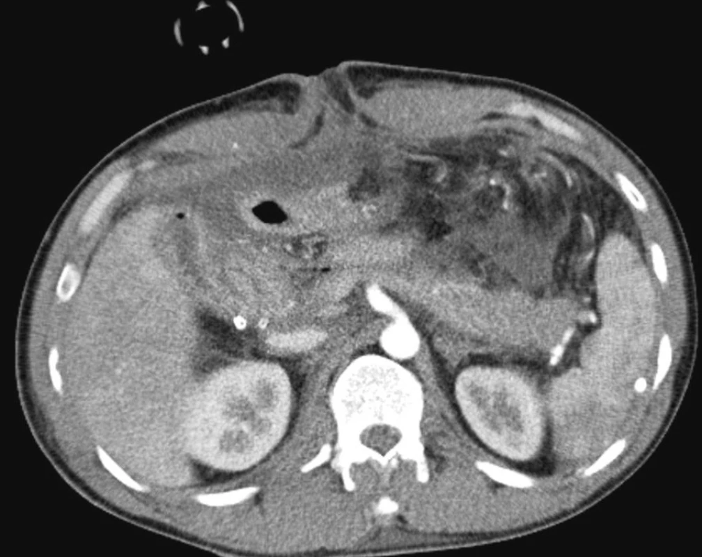 CT obraz poranění: Kavo-duodenální píštěl a poranění hlavy pankreatu
Fig. 1. CT view of the trauma: Cavo-duodenal fistule and the pancreatic head trauma
