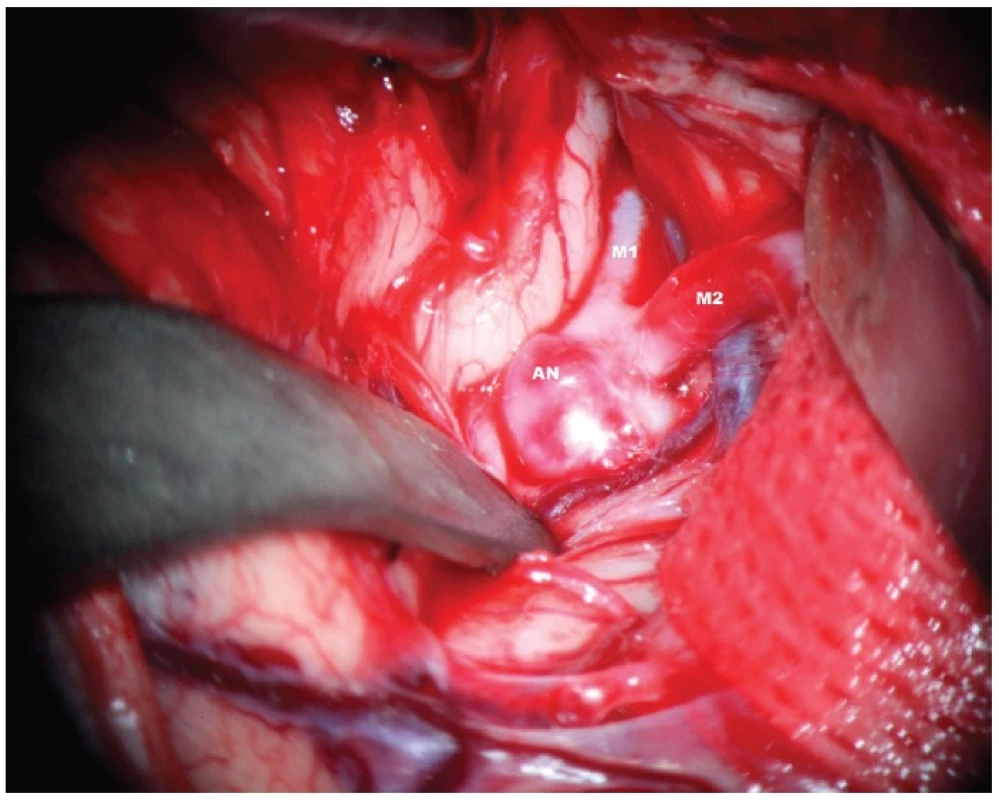 Disekce Sylvijské cisterny s patrným aneuryzmatem M1/2. AN – aneuryzma, M1 – kmen a. cerebri media. M2 – temporální větev bifurkace ACM
Fig. 2: Dissection of the Sylvian fissure – obvious aneurysm of MCA bifurcation. AN – aneurysm, M1 trunk of MCA, M2 temporal branch of MCA
