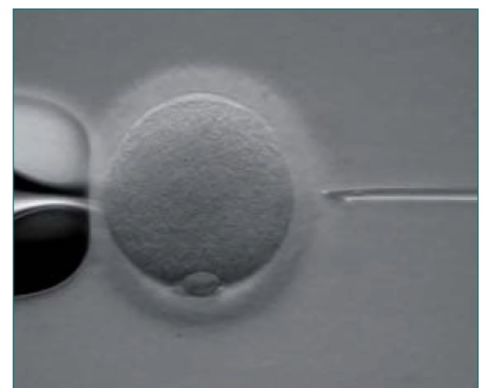 ICSI – vlevo „holding“ pipeta držící oocyt, vpravo mikropipeta s nasátou spermií připravena k injekci spermie do vajíčka.