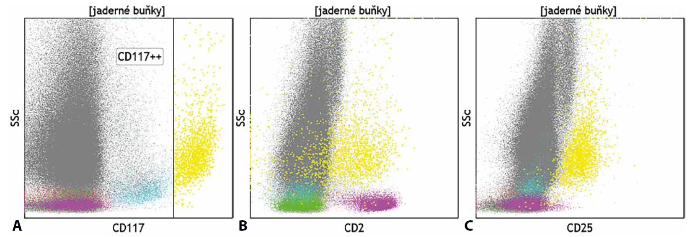 (A) Identifikace mastocytů (žlutě) na základě silné exprese znaku CD117 a jejich aberantní exprese znaků (B) CD2 a (C) CD25 u pacienta se systémovou mastocytózou.