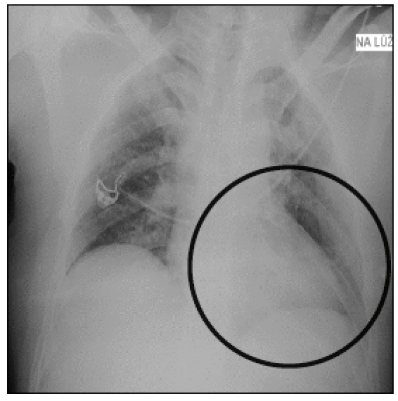 Negtivní vstupní RTG snímek hrudníku