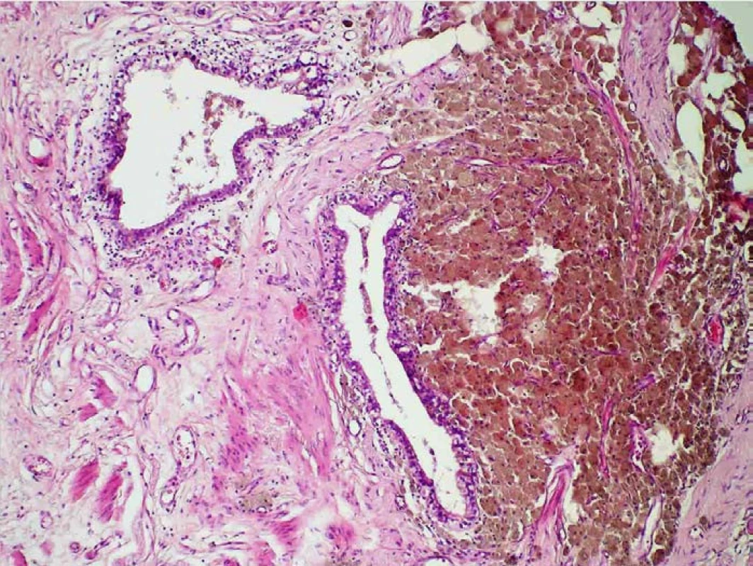 Histologický preparát endometriózy, barvení hematoxilin-eozin. Originální objektiv 10×. Jsou patrné dvě žlázky charakteru žlázek korporálního endometria a vpravo na snímku hojné siderofágy ve stromatu.
