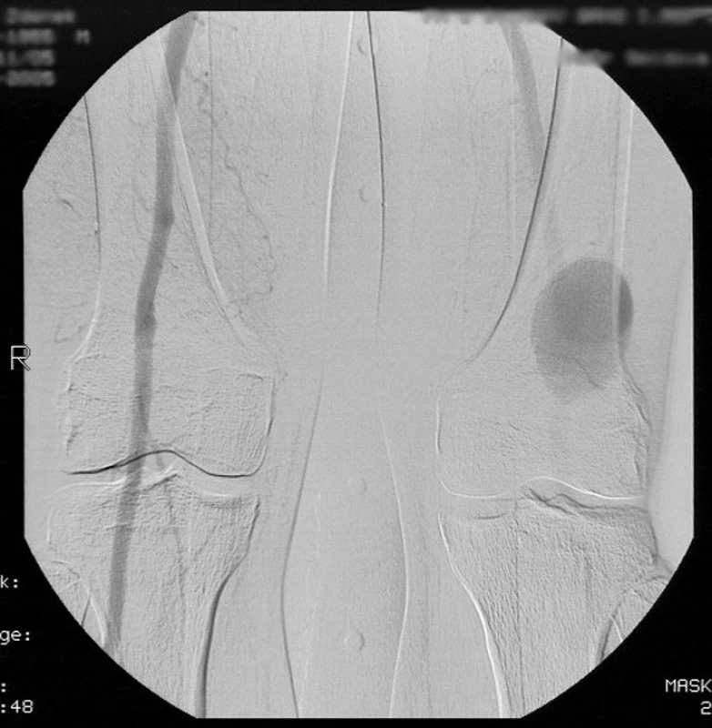 Peroperační RTG snímek implantovaného bifurkačního stentgraftu Zenith.
Pic. 3. Intraoperative X-ray of implanted stent graft Zenith.
