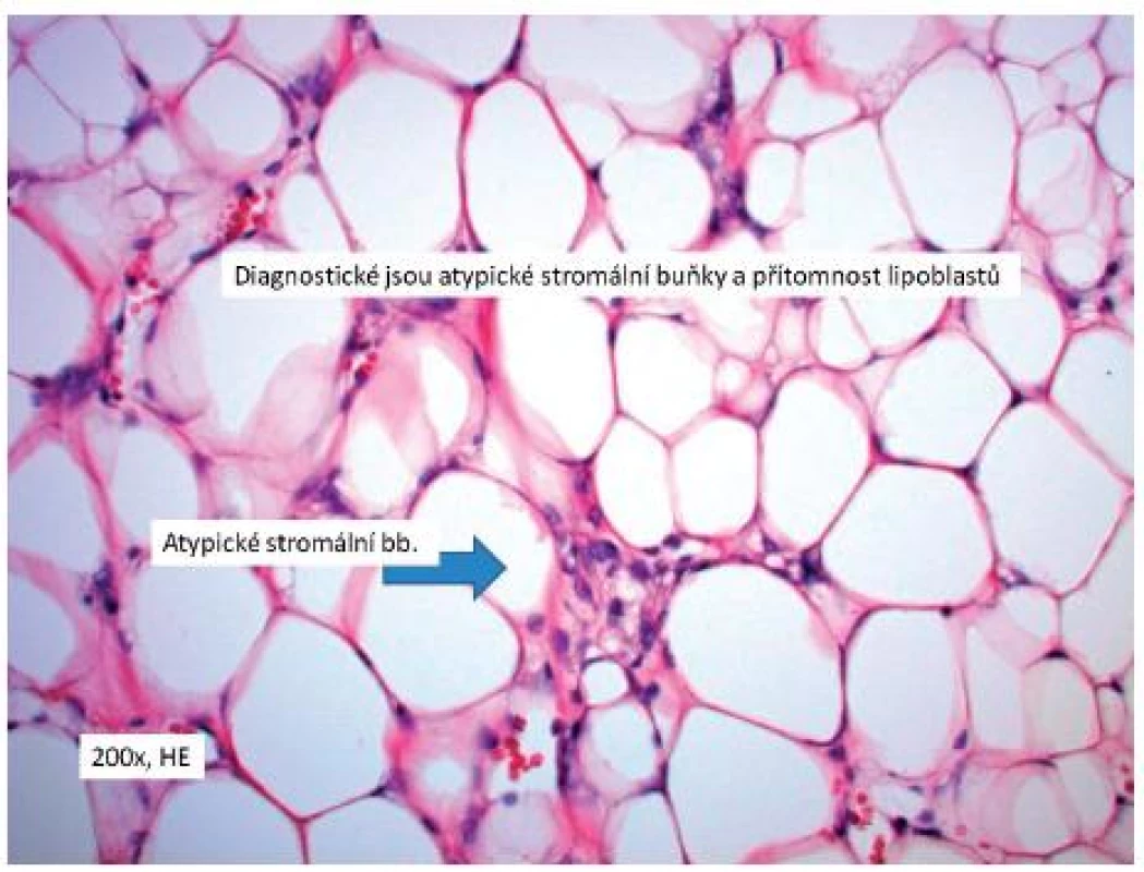 Diagnostické jsou atypické stromální buňky a přítomnost lipoblastů (200× HE)
Fig. 3. Atypical stromal cells and presence of lipoblatomas are typical (200× HE)