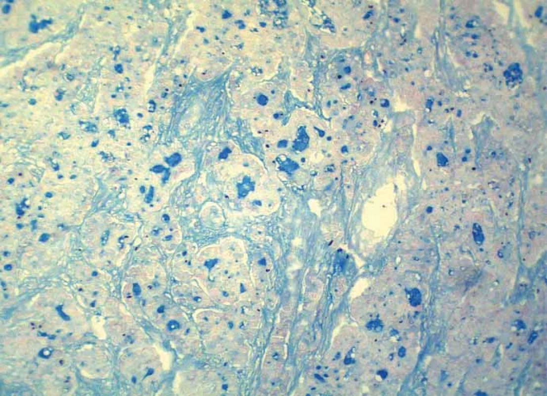 Intraluminous mucin production within tumor tissue (alcian blue, magnification 200×).