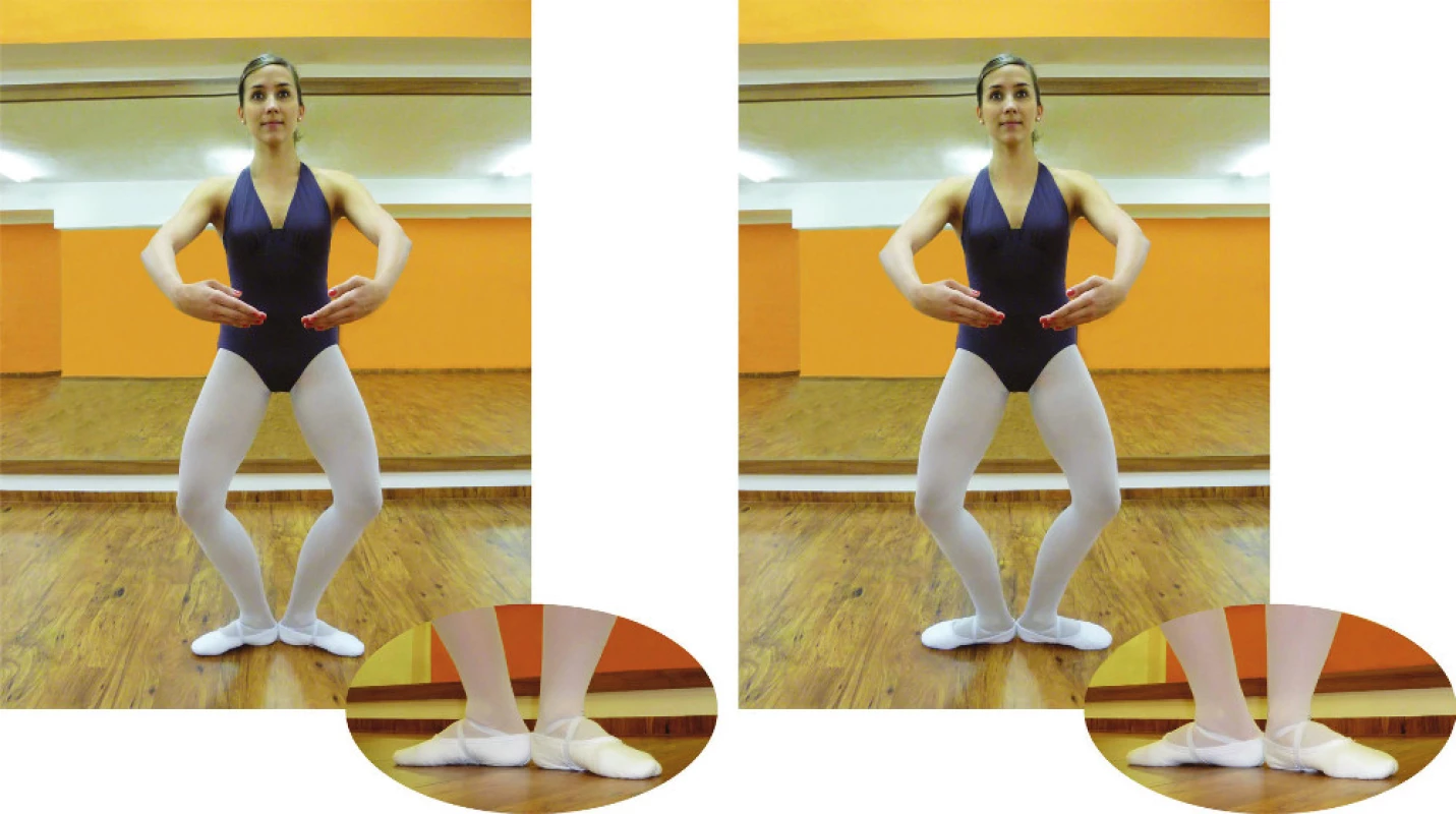 Správné (vlevo) a kompenzační &lt;em&gt;(“rolling in“)&lt;/em&gt; (vpravo) postavení nohou baletní tanečnice v pozici demi-plié.
