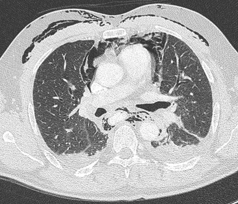 Axiální obrazy CT pneumomediastinum v plicním okénku
Fig. 6. Axial CT views of the pneumomediastinum in the lung window