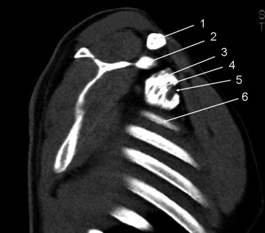 Infraklavikulární přístup, 30 ml kontrastní látky
Vysvětlivky: 1 – klíční kost; 2 – korakoidní výběžek; 3 – náplň pochvy brachiálního plexu; 4 – projasnění nervu; 5 – arteria subclavia; 6 – první žebro.