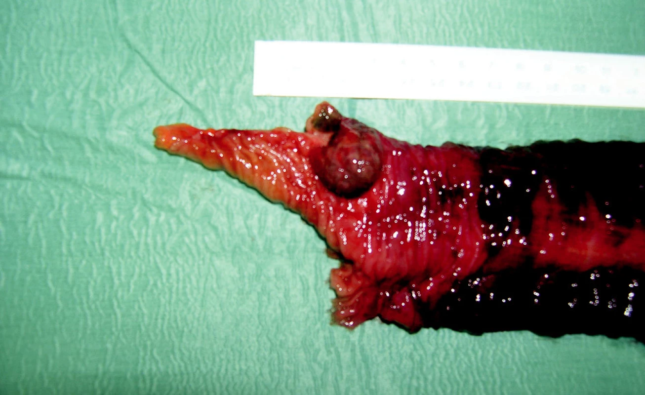Stopkatý tumor distálního ilea – maligní melanom
Fig. 5. The stem tumor of the distal ileum – melanoma malignum