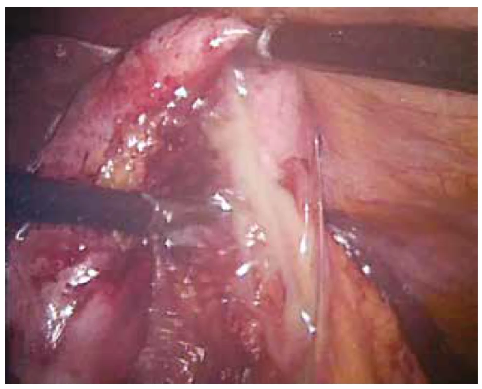 Perforace flegmonózního žlučníku s empyémem<br>
Fig. 5: Perforation of phlegmonous gallbladder with empyema