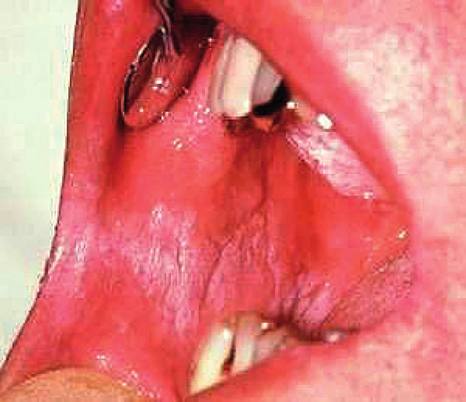 Verukozná leukoplakia na bukálnej sliznici v okluzálnej línii (Ďurovič)