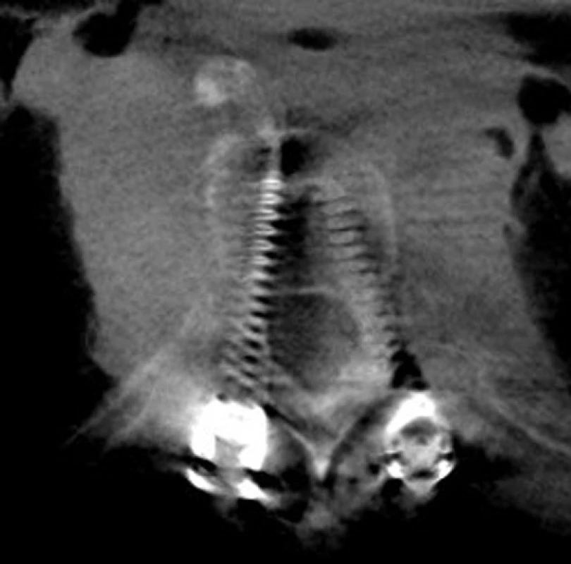 CT dokumentace 52letého pacienta s inveterovanou zlomeninou T8 s přemosťujícími ventrálními osteofyty a) 2D rekonstrukce předoperačního CT vyšetření v sagitální rovině, na kterém je patrná nestabilní extenční zlomenina T8, b) 2D rekonstrukce peroperačního CT vyšetření v sagitální rovině v oblasti levých pediklů se správně zavedenými transpedikulárními šrouby, c) 2D rekonstrukce peroperačního CT vyšetření v transverzální rovině v oblasti pediklů T6 se správně zavedenými transpedikulárními šrouby.
Fig. 2: CT documentation of a 52-year-old male after an inveterate fracture of the eighth thoracic vertebra a) 2D sagittal reconstruction of preoperative CT showing non-stable fracture, b) 2D sagittal reconstruction of intraoperative CT in the level of left pedicles showing the correct position of transpedicular screws, c) 2D transversal reconstruction of intraoperative CT in the level of the sixth thoracic vertebra pedicles showing the correct position of transpedicular screws.