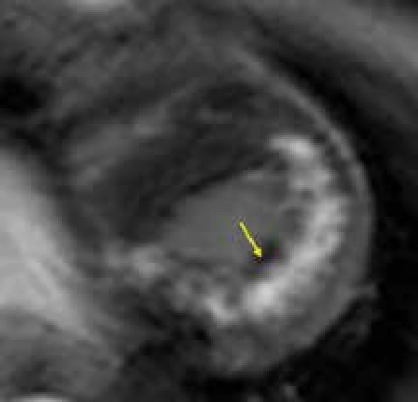 Silný intramurální pruh LGE (žlutá šipka) v celé délce volné stěny levé komory, přesahující na hrot  a vynechávající oblast interventrikulárního septa, u nemocného s Danonovou chorobou