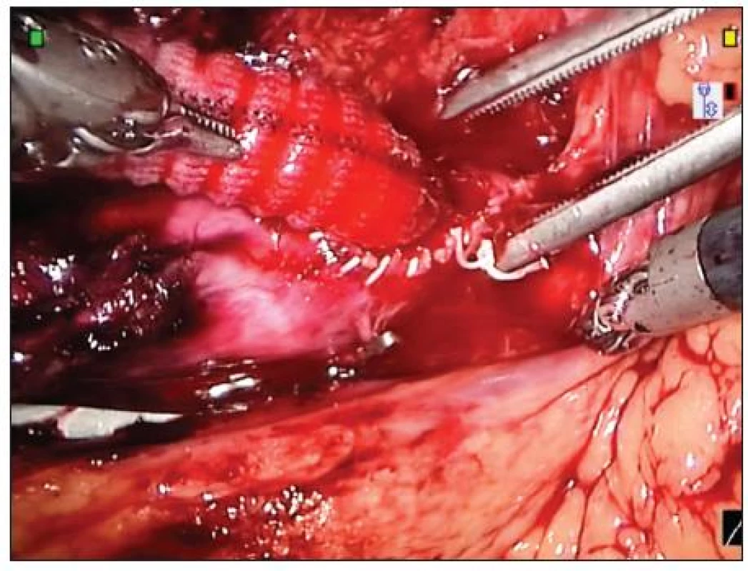 Centrální anastomóza na abdominální aortě
Fig. 4. Proximal anastomosis of abdominal aorta