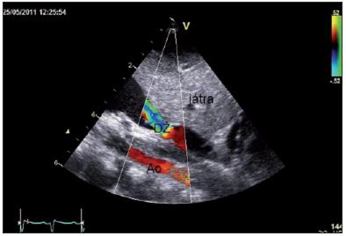 Subkostální sagitální projekce: distální žíla (DŽ) – žilní kmen, derivující confluens plicních žil, zachyceno po průchodu bránicí, s obstrukcí (gradient podle kontinuálního Dopplera 9/6 mmHg) při vústění do vena portae.
Fig. 3. Subcostal long axis view: distal vein – venous stem, deriving confluence of pulmonary veins as detected in coming through the diaphragm and with obstruction (gradient according to continuous Doppler 9/6 mmHg) in outfall into portal vein.