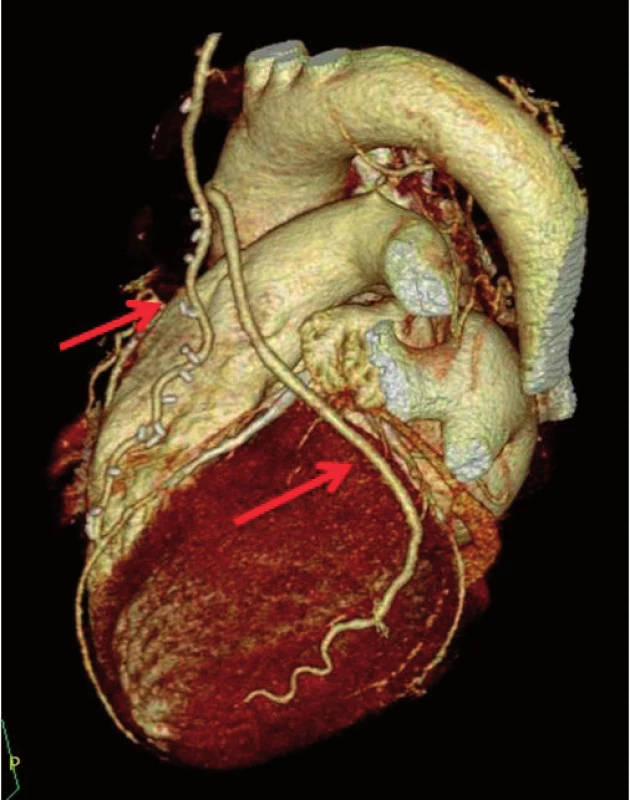 3D rekonstrukce pacienta po aortokoronárním bypassu. Šipky ukazují volně průchodný arteriální bypass LIMA-RIA a volně průchodný žilní bypass na ramus marginalis sinister (RMS).