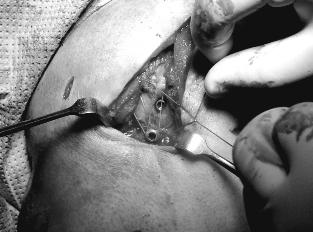 Fixace hrbolků pomocnými stehy k distálními laterálnímu šroubu, proximální šroub je již zanořen
Pic. 2. Fixation of the tuberi to the distal lateral screw with secondary stitching, the proximal screw is already immersed