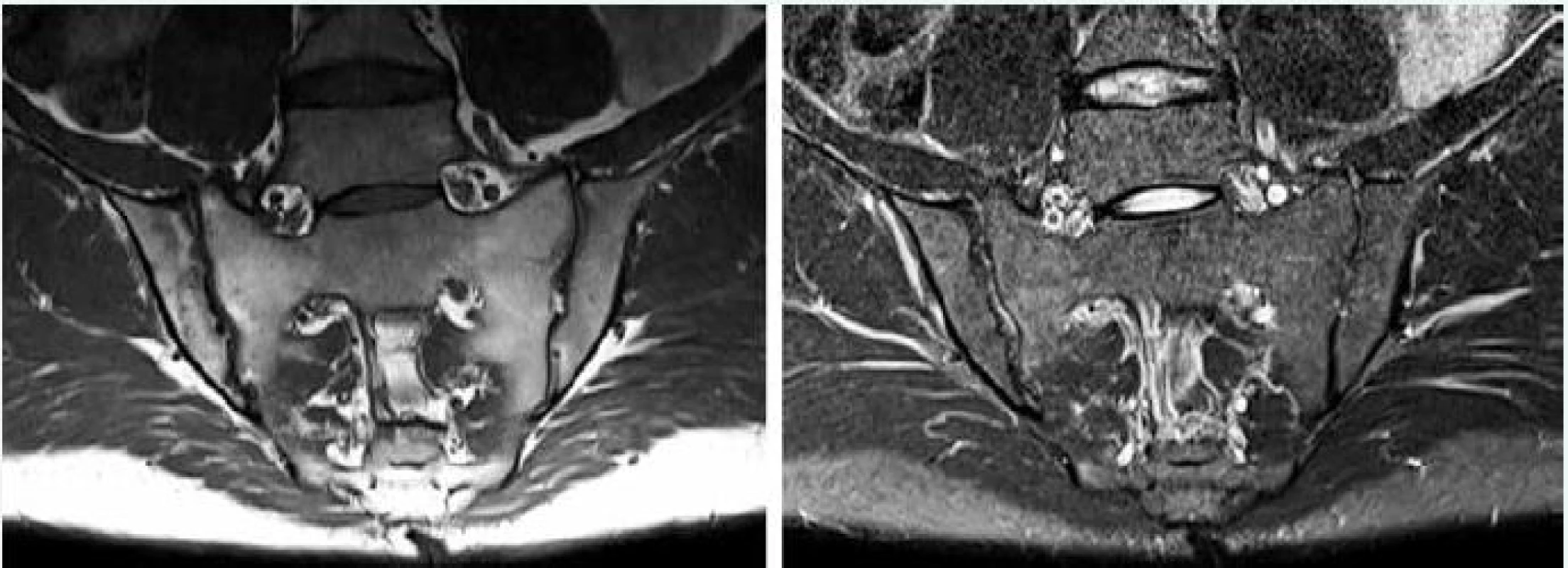 MRI sekvencie pre zobrazenie sakroiliakálnych kĺbov. Vľavo T1-vážený obraz (T1W, T1 tse) senzitívny pre tuk, vpravo STIR sekvencia senzitívna pre tekutinu. Archív autora