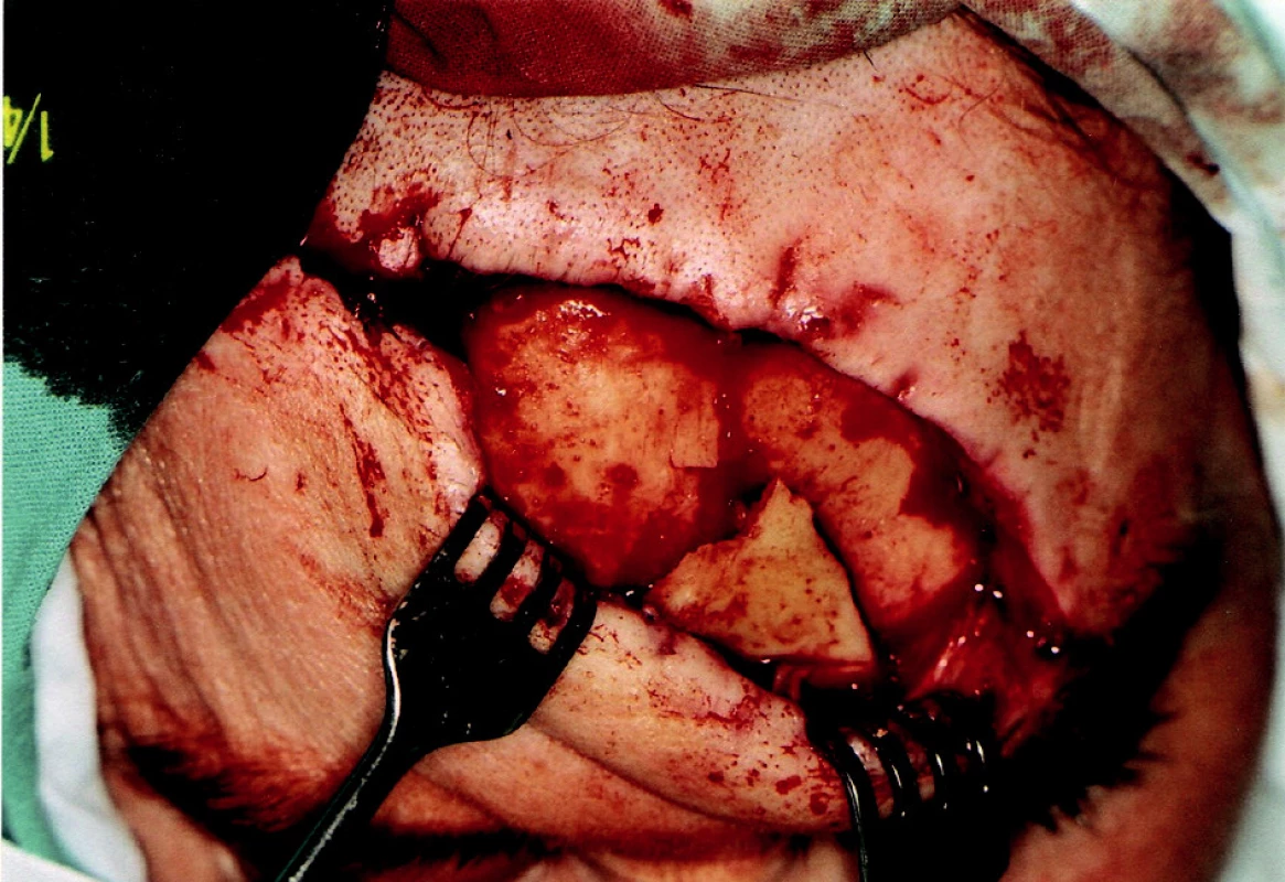 Pacient zo sledovaného súboru so zlomeninou vo frontálnej a supraorbitálnej oblasti pred repozíciou a fixáciou fragmentov. Chirurgický prístup využívajúci tržnú ranu.