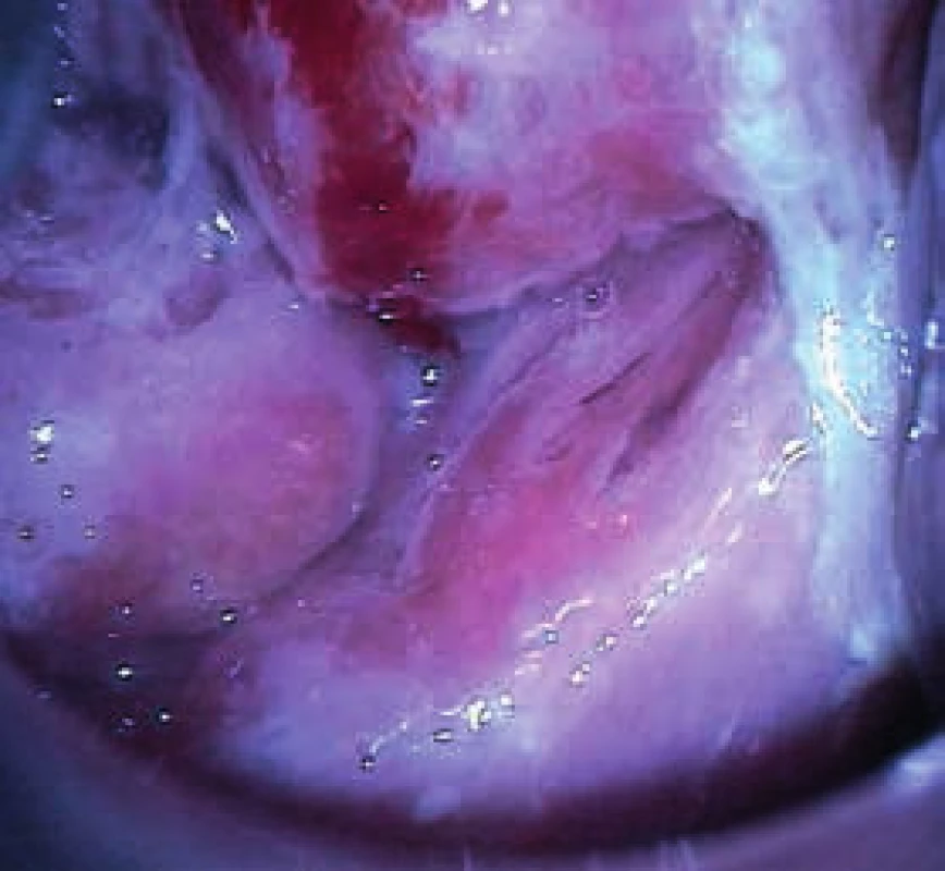 Kazuistika 3. Dolní část ektocervixu – atypická transformační zóna typu II–III, patrná hrubá makroskopická deformace objemného cervixu