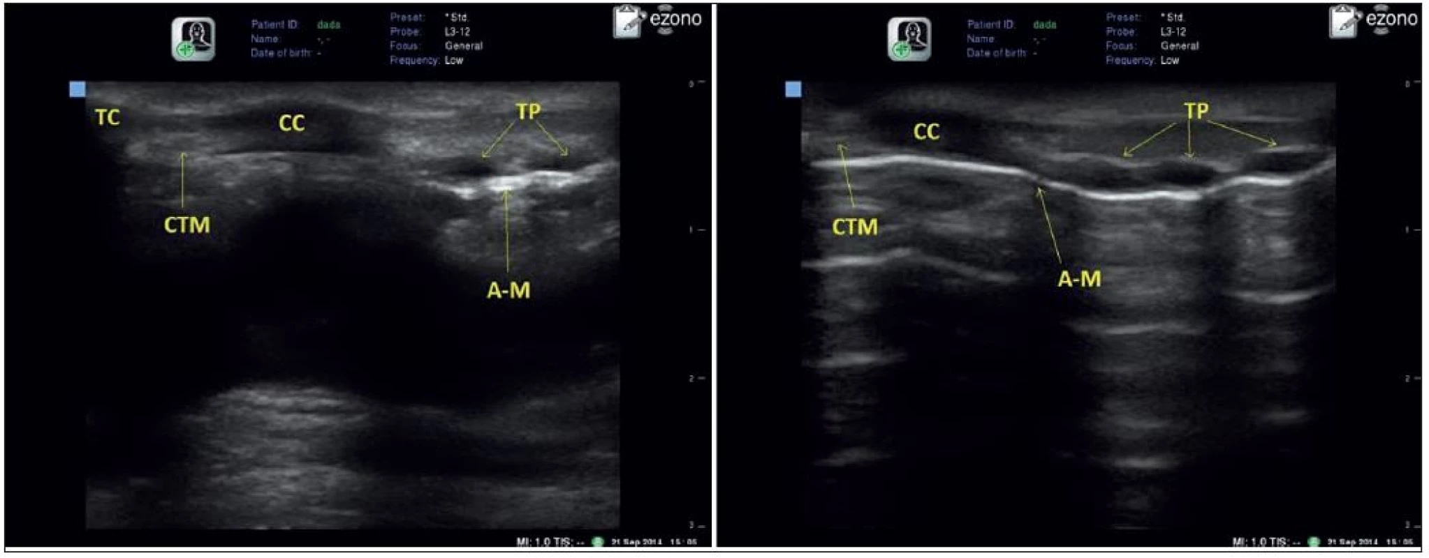 Longitudinální zobrazení v úrovni krikothyreoidní membrány (CTM), thyroidní chrupavka (TC), krikoidní chrupavka (CC), tracheální prstence (TP), Air-mucosa artefakt (A-M)
