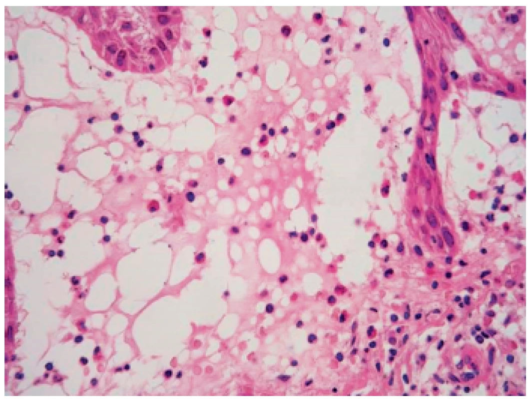 Subepidermální bula s neostrou dermální hranicí a obsahem lymfocytů a eozinofilů – detail