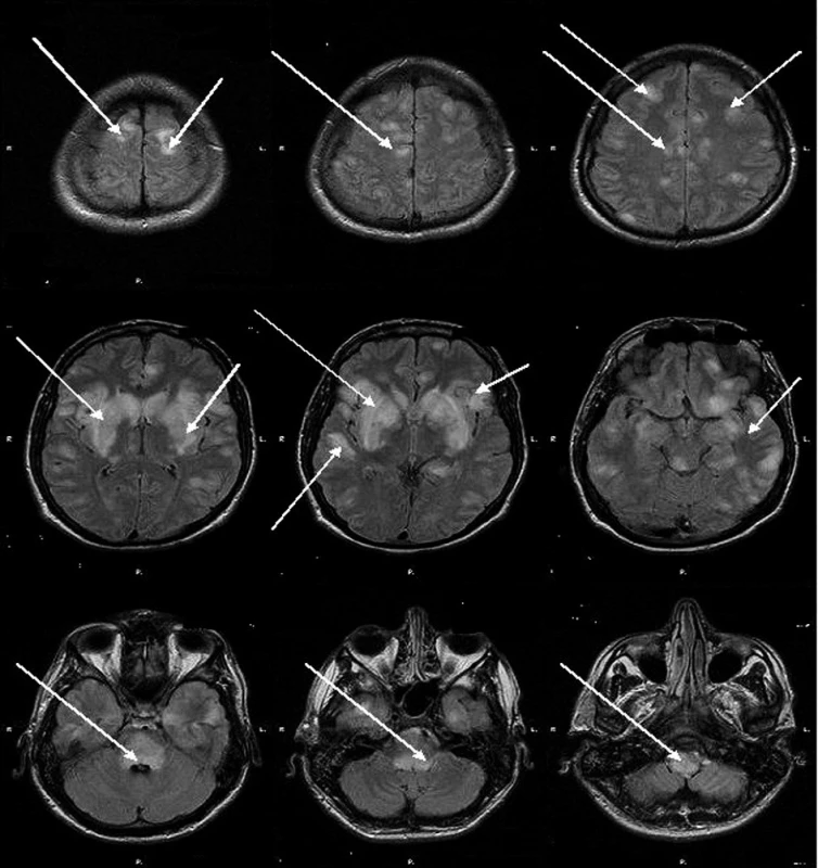 MRI mozku – flair skeny