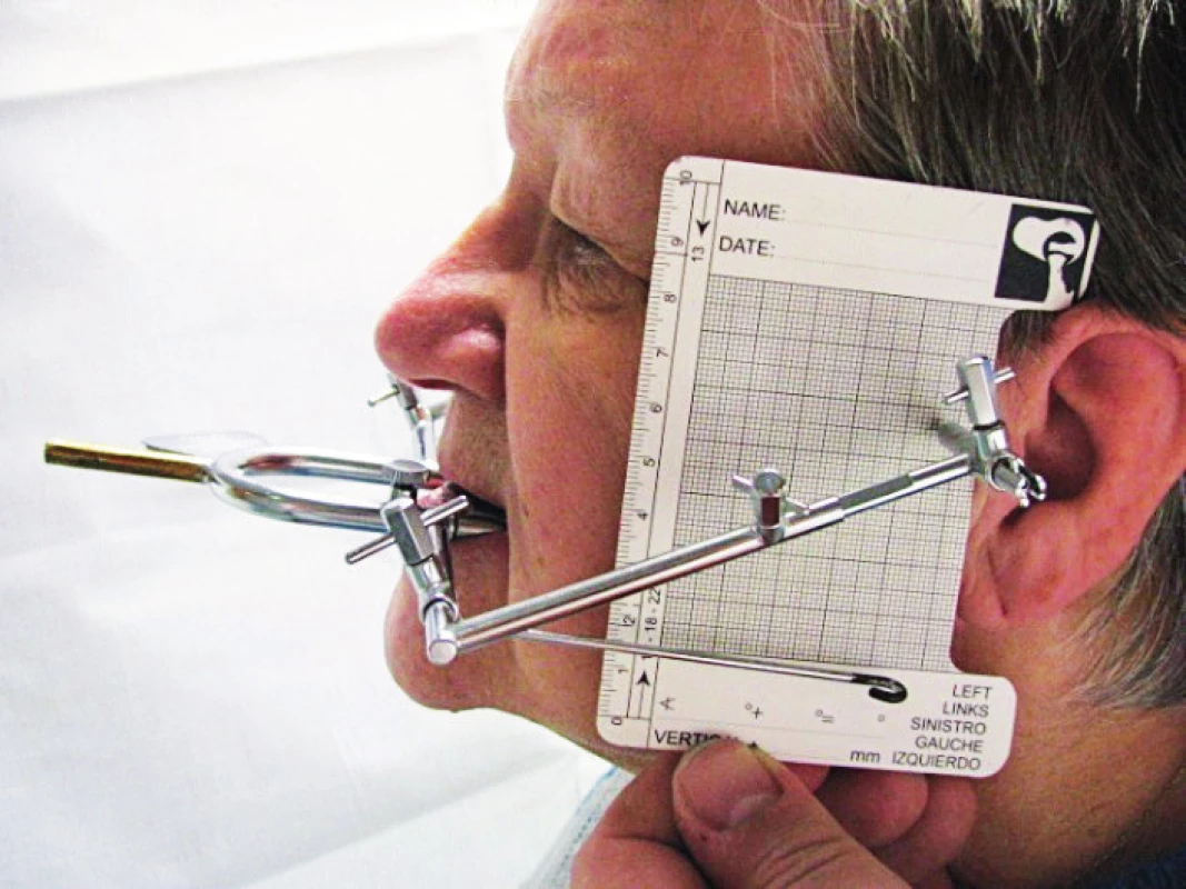 Nasazený Gerberův obličejový oblouk s grafickým registračním zařízení zaznamenávajícím úhel a trajektorii pohybu kondylu při protruzním pohybu (foto autoři)