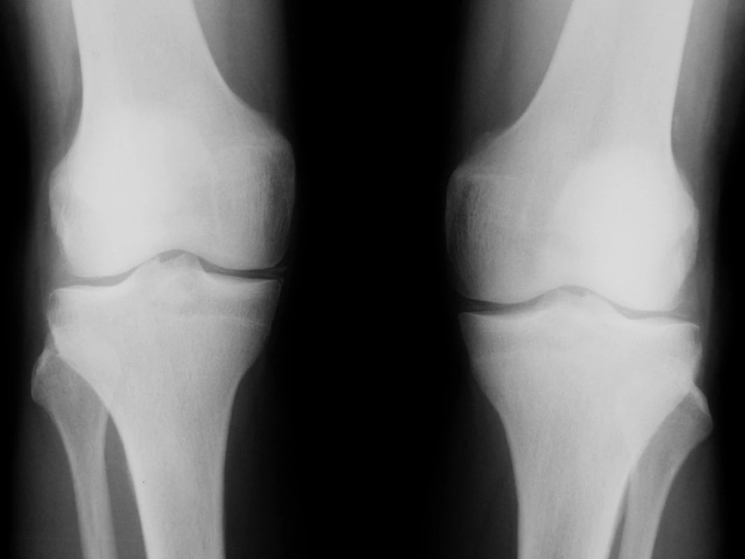 Radiogramy kolenních kloubů padesátišestileté nemocné s Gitelmanovým syndromem s obrazem chondrokalcinózy. Jsou patrné lineární stíny kalcifikační sytosti podél kloubních plošek intraartikulárních chrupavek a rovněž kalcifikace v měkkých periartikulárních tkáních podkolenní
jamky.