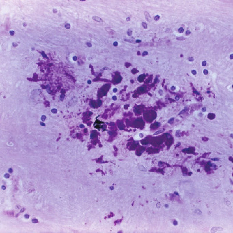 Výsledná cerebrální mikrogranulomatózní léze – mikrogliální uzlík vzniklý na základě resorpce mikrobiální plaky při postižení mozku u Wh. nemoci.