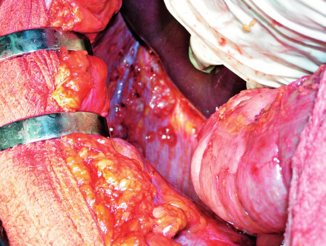 Peritoneální metastázy KRK na levé bránici