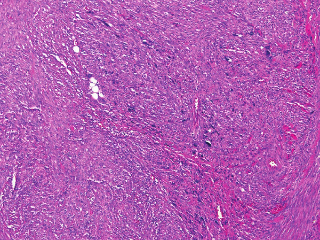 Leiomyosarkom s bizarními buňkami Hematoxylin-eosin, zvětšení 100x.
Fig. 2: Leiomyosarcoma with bizarre cells Hematoxylin-Eosin, 100x magnification.