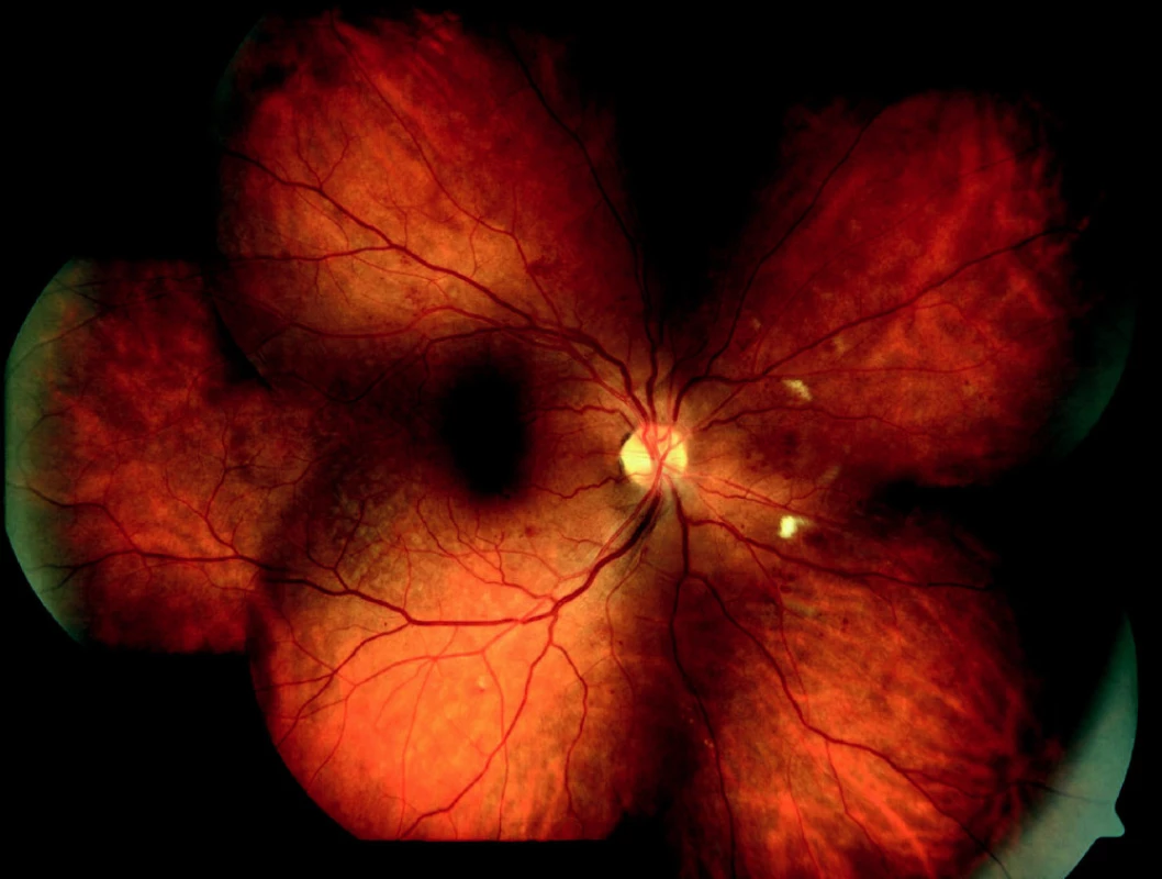 Středně pokročilá forma neproliferativní diabetické retinopatie