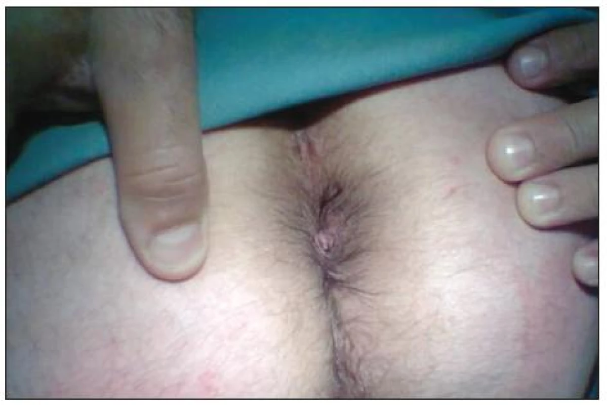 Anus měsíc po operaci
Fig. 4. Result one month after procedure