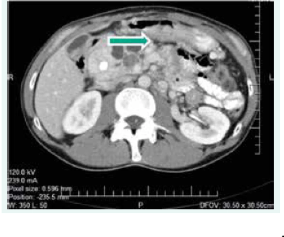 CT scan abdomenu z roku 2006 (ložiská v pankrease)