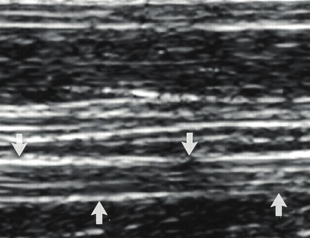 Podélný ultrazvukový obraz periferního nervu (označen šipkami) Hypoechogenní (tmavé) linie odpovídají průběhu jednotlivých fasciklů, hyperechogenní (světlé) přerušované linie představují ultrazvukový obraz epineuria.
