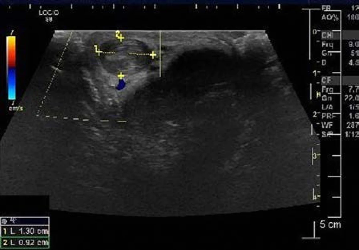 Venózní trombóza v povrchové penilní žíle
Fig. 2 Venous thrombosis of the superficial penile vein