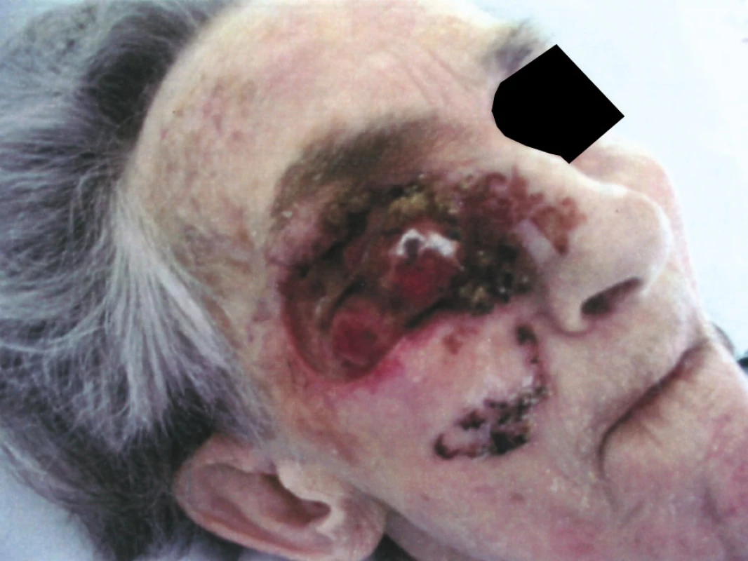 Rozsáhlý exulcerovaný basaliom tváře u imobilní staré ženy
Fig. 2. Extensive exulcerated basalioma of the face in an immobile elderly female