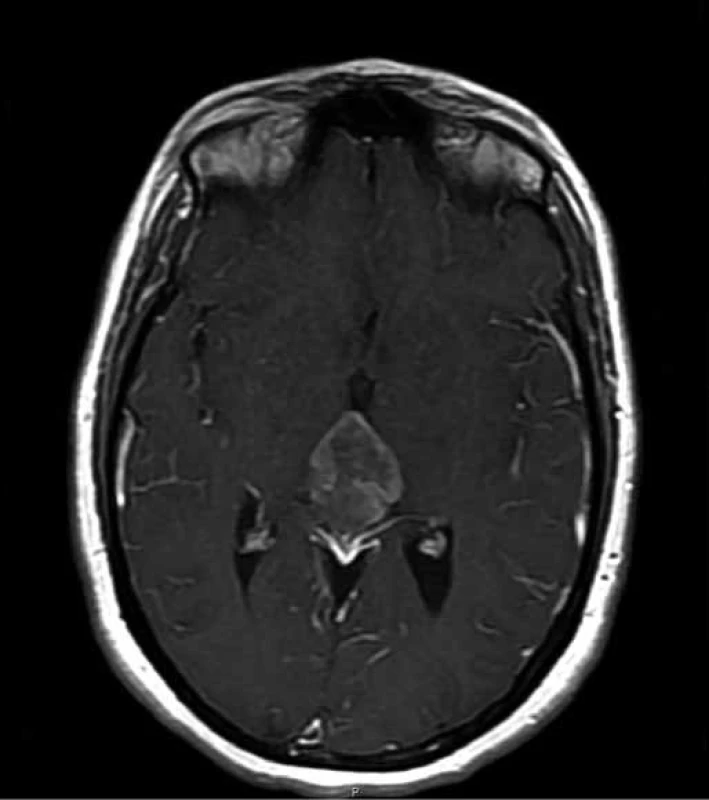 Preoperative transversal T1 MRI constrast enhanced section showing the pineal mass (max. diameter of 3.9 cm).