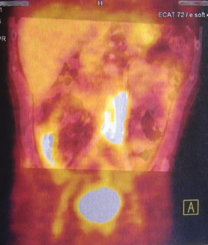PET (pozitronová emisní tomografie) – zvýšený metabolizmus v retroperitoneu při infekci bifurkační cévní protézy.