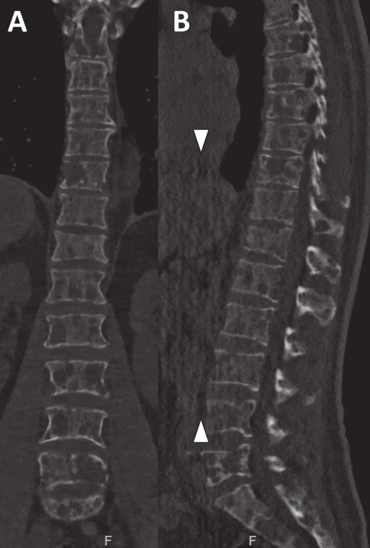 Nízkodávkové CT skeletu ukazuje rozsáhlé osteolytické postižení hrudní a bederní páteře u pacienta s mnohočetným myelomem