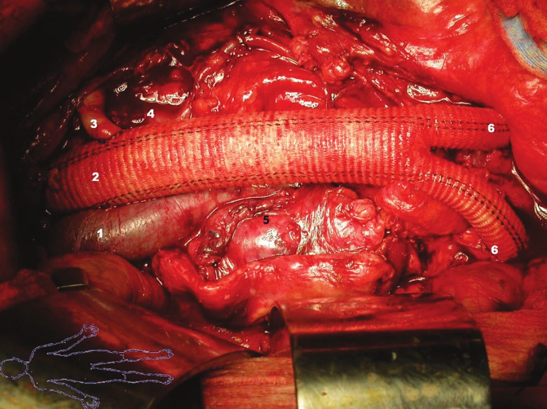 Konečný stav:
1 – vena cava inferior
2 – bifurkační protéza
3 – reimplantovaná arteria renalis sinistra
4 – vena renalis sinistra
5 – prošitý okraj vaku aneuryzmatu
6 – end-to-side anastomóza ramének bifurkační protézy na pánevní tepny
Fig. 4. Final condition:
1 – vena cava inferior
2 – bifurcated prosthesis
3 – reimplanted left renal artery
4 – left renal vein
5 – stitched aneurysmal sac
6 – end-to-side anastomosis of the bifurcation prosthesis branches to pelvic arteries