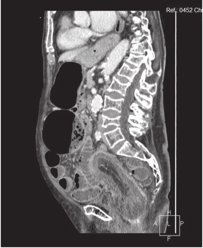 CT obraz invaginace v oblasti colon sigmoidei a obraz ileu, sagitální řez
Fig. 3: CT image of invagination in the sigmoid colon area and ileus, sagittal section