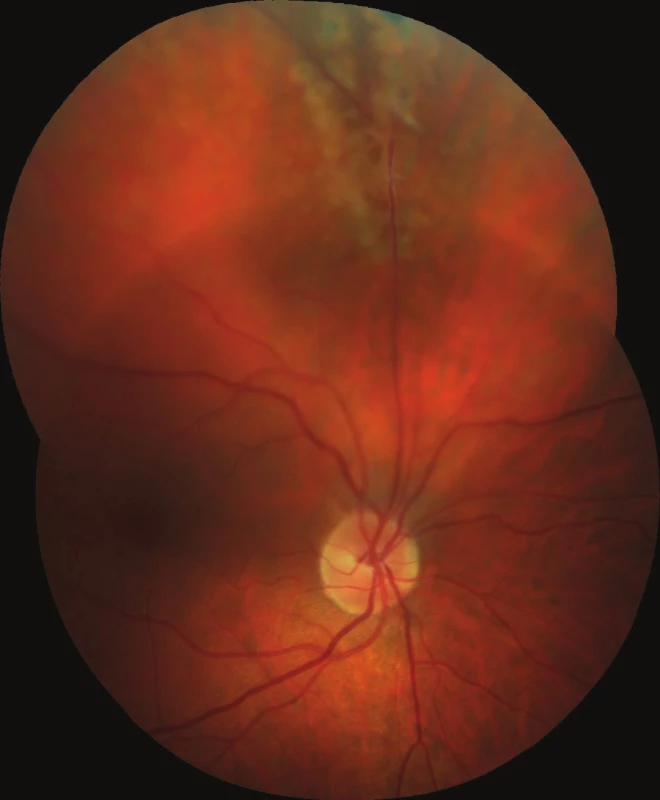Barevný fotografický snímek fundu pravého oka: proximální úsek perzistující arteria hyaloidea upínající se k horní temporální arkádě s lokálním trakčním odchlípením sítnice staršího data