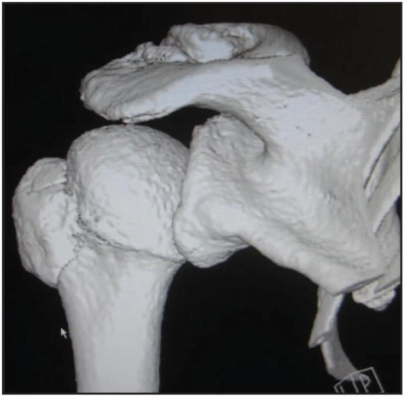CT obraz zreponované luxační zlomeniny proximálního humeru